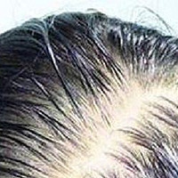 脂溢性脱发可以自愈吗？13大护发方法一定要掌握！