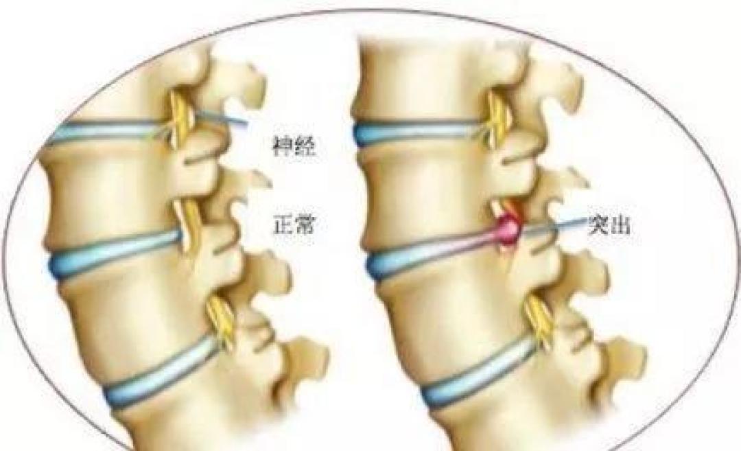 健身减肥小知识:普遍问题讲解——如何去除小腹赘肉