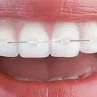 关于牙齿矫正的这些问题，你值得一看！