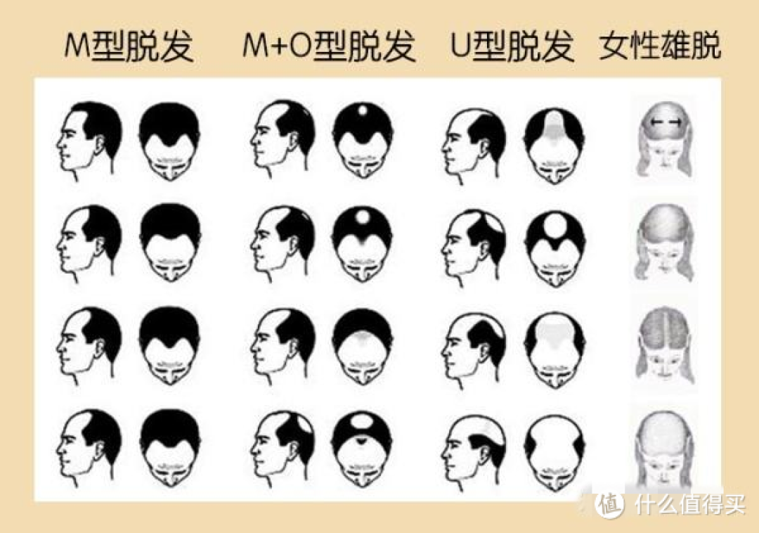 “贝克汉姆快秃头了”登上热搜,和雄激素作战可能是一辈子的事~