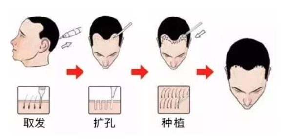 拯救脱发患者的终极方法，关于植发你该了解这些