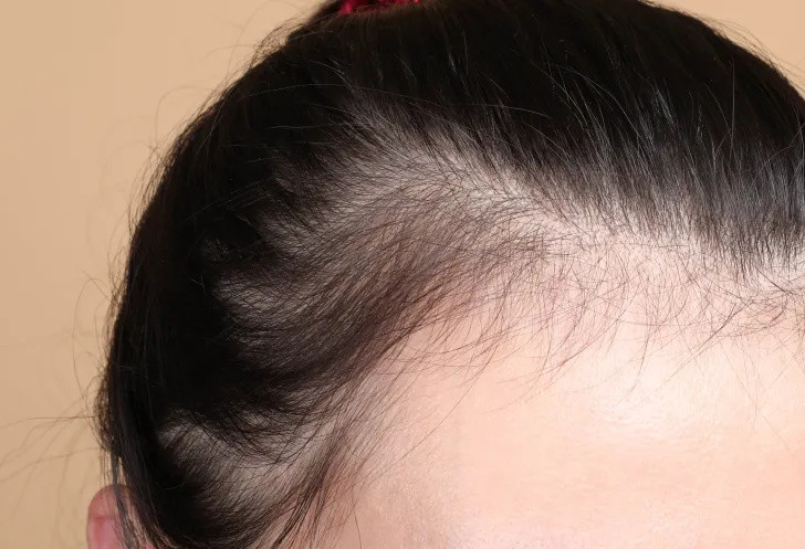 在植发前，你还可以这样拯救发际线。