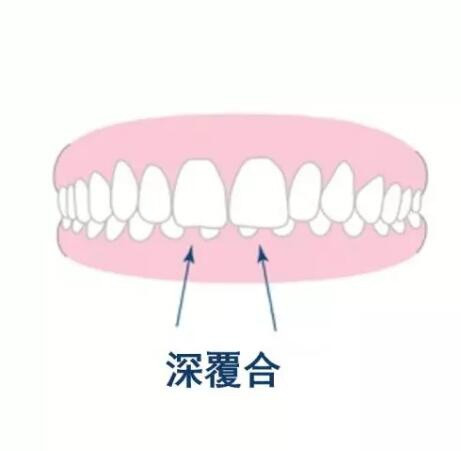 下巴短有可能是牙齿问题引起的，深覆合了解一下？