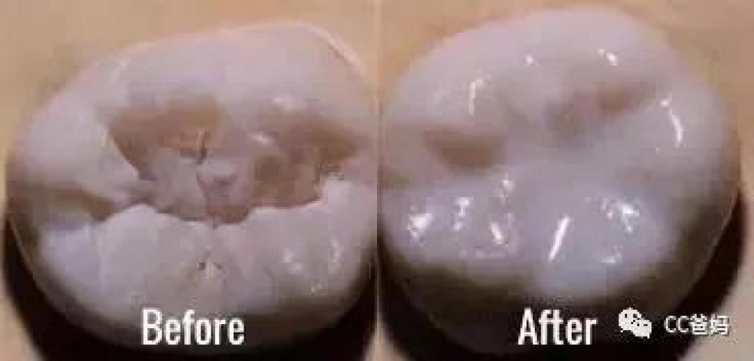 双排牙是否要拔掉?地包天几岁矫正最合适?纯干货科普,教你保护孩子的牙齿