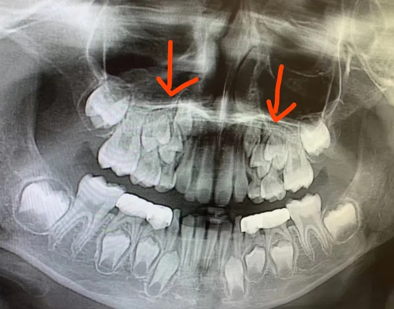 “旧牙不掉新牙就长、歪七扭八？”比出牙崩溃100倍，关于小娃换牙的那些糟心事儿