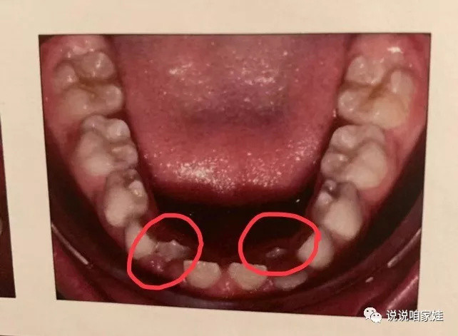 “旧牙不掉新牙就长、歪七扭八？”比出牙崩溃100倍，关于小娃换牙的那些糟心事儿