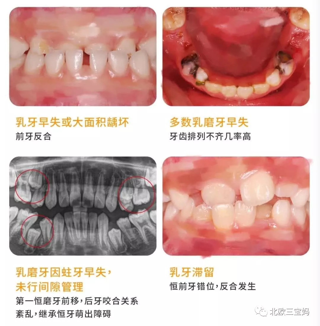 没有牙不好的娃，只有不负责的爹妈！这些护牙误区你中了几个？