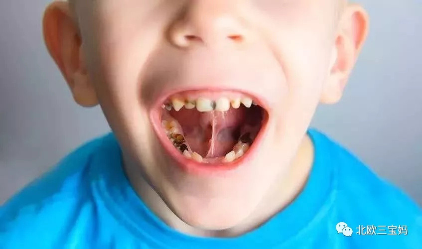 没有牙不好的娃，只有不负责的爹妈！这些护牙误区你中了几个？