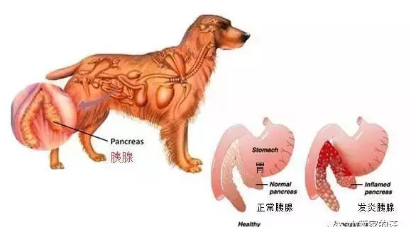 胰腺炎要低脂？到底多少才算低？