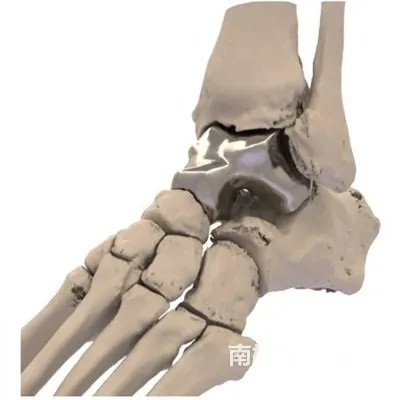 首个3D打印距骨植入物获得FDA批准，Additive Orthopaedics公司