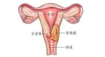 宫颈癌在哪个位置图片图片
