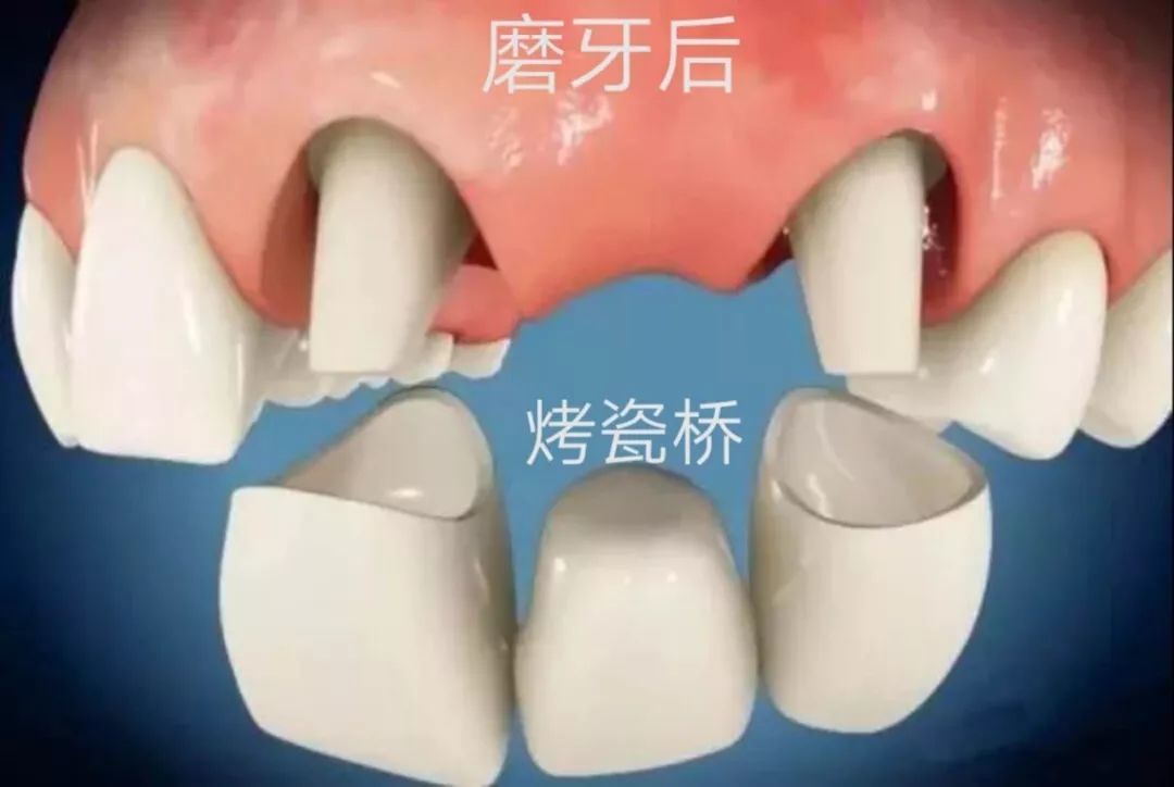 中国人最常见的烤瓷牙,评价褒贬不一,牙医告诉你该做还是不该做?
