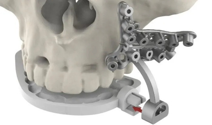 3D SYSTEMS推出VSP混合颌面外科手术导板