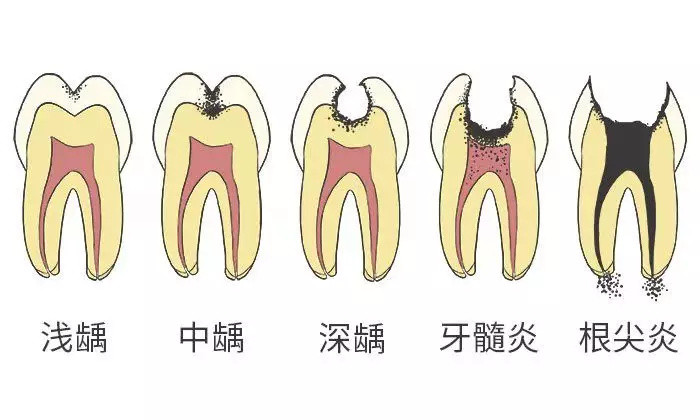 让孩子拥有一口好牙的“秘密”（附巴氏刷牙法）