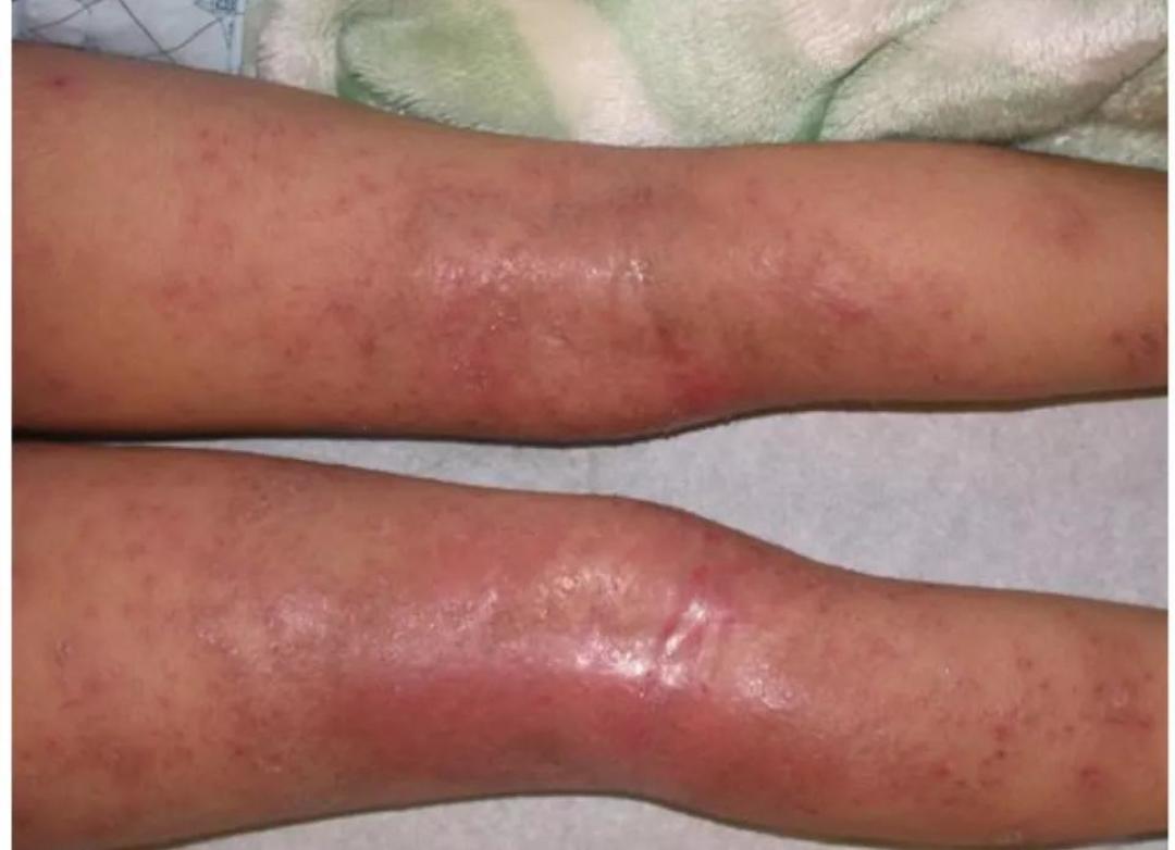 湿疹痱子如何分辨怎么处理让我们来看图说话一文讲清