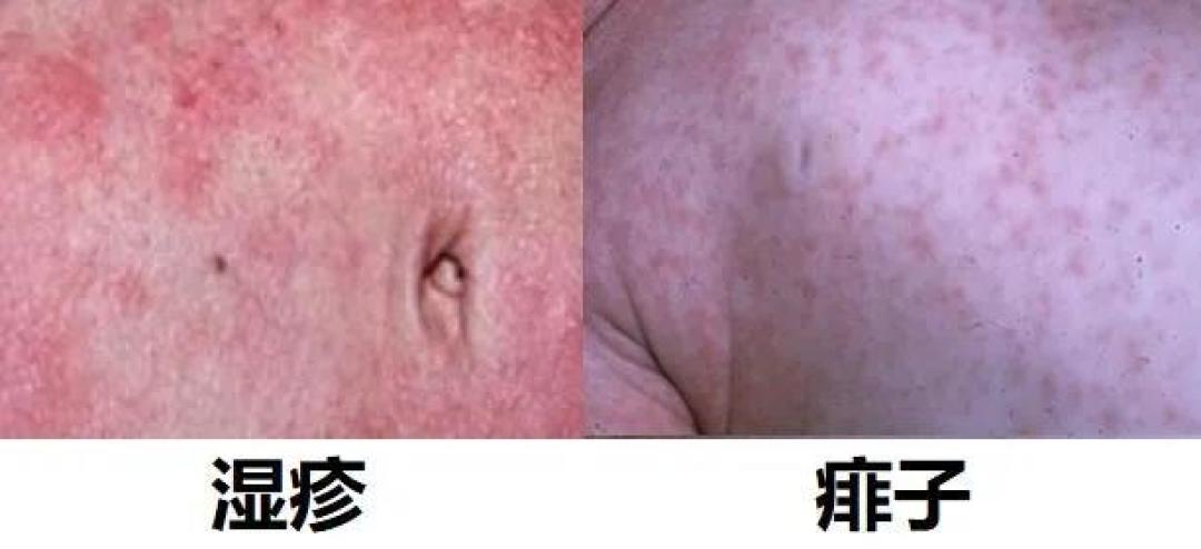 2,皮疹形态湿疹一年四季都可发病,痱子好发于夏季.
