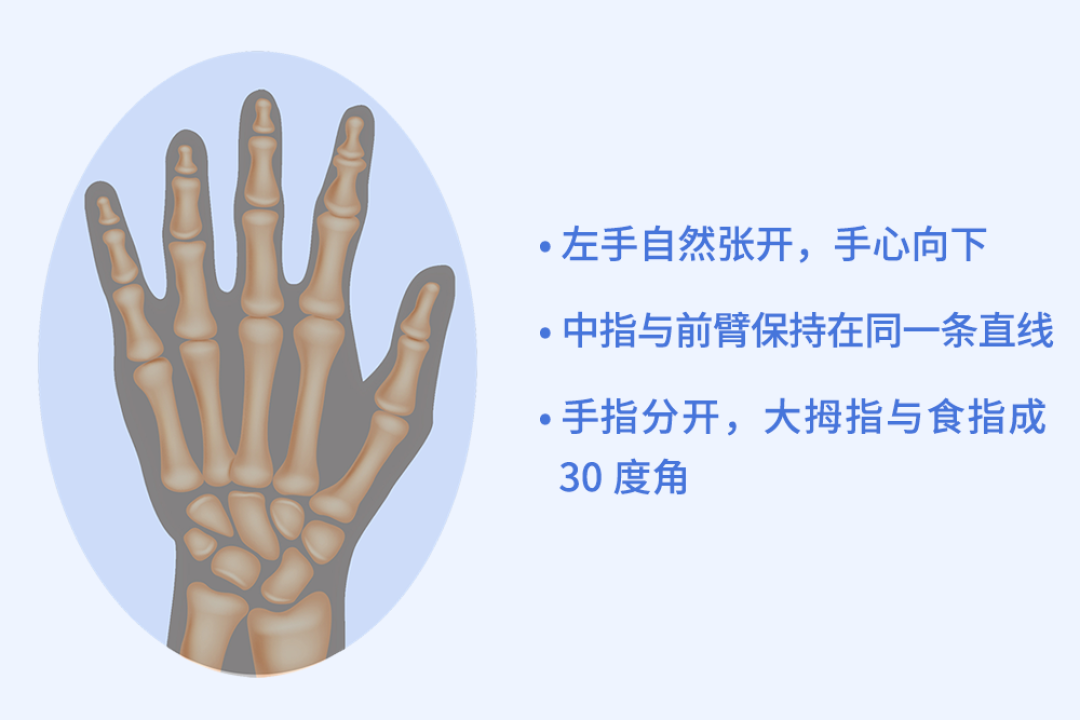 骨龄的测定很简单,只需拍一个手腕部的x光片.