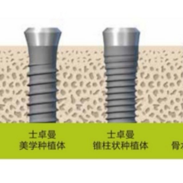 缺牙人士看过来：国际公认最稳定的种植体——士卓曼（ITI），究竟怎么样？