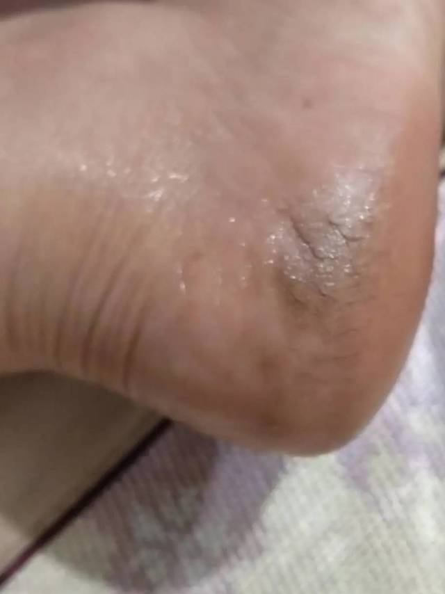 脚裂灵