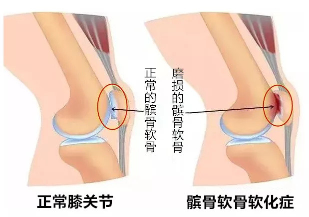 新力作21期:警惕!男子骑动感单车,45岁的膝盖跟60岁的差不多了...