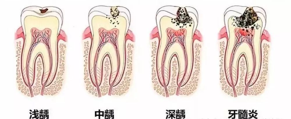 根管治疗作为一个人见人怕的项目，究竟是个啥？