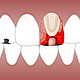 牙髓炎可以自愈吗？牙髓炎牙龈炎牙周炎有什么区别？关于牙髓炎你需要知道的
