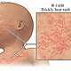 痱子、湿疹要分清，护理方法大不同！教你1图读懂～