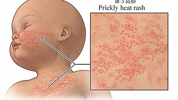 痱子、湿疹要分清，护理方法大不同！教你1图读懂～