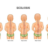 超500万儿童脊柱侧弯，这个坐姿要改掉！(附脊柱侧弯家庭自测法)