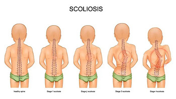 超500万儿童脊柱侧弯，这个坐姿要改掉！(附脊柱侧弯家庭自测法)