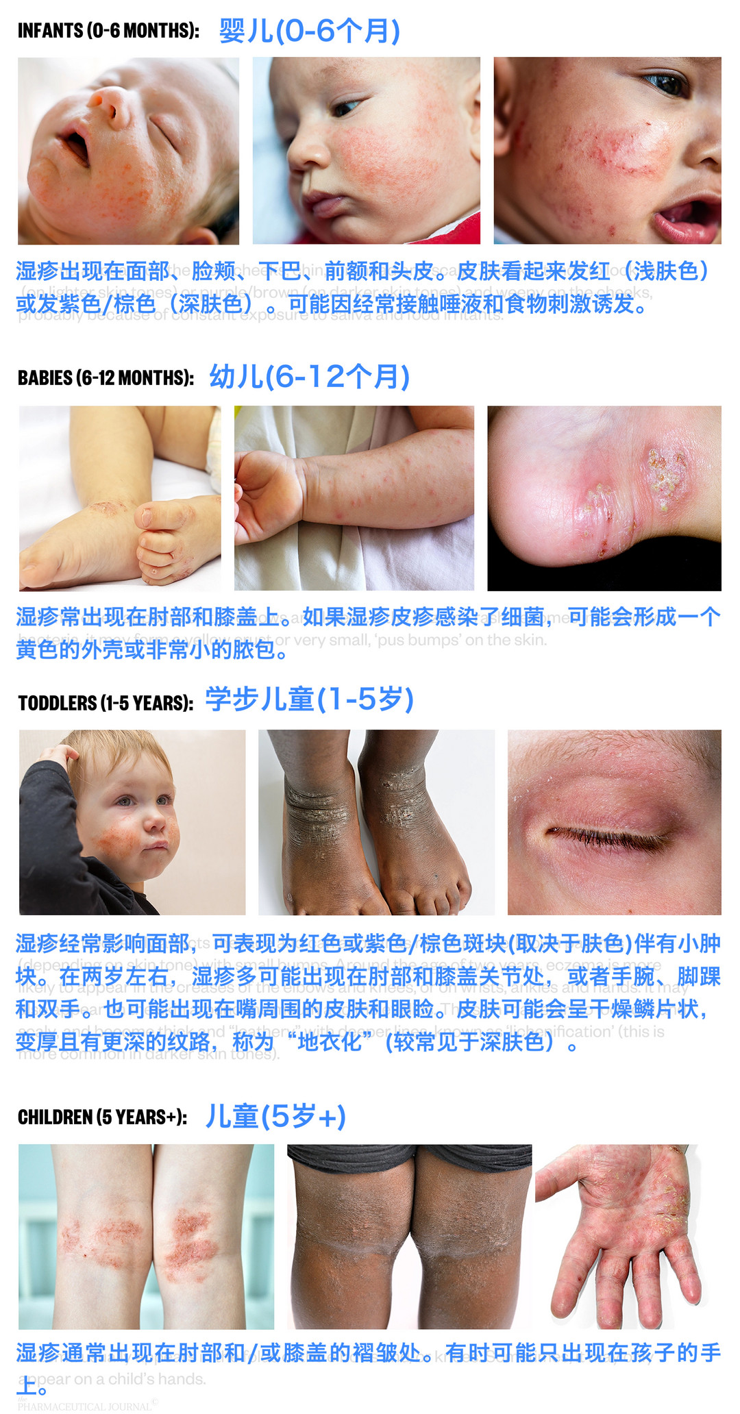 图源:Managing childhood eczema: a visual guide