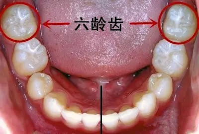 儿童患龋率高发，预防「六龄齿」病是关键！6招给孩子一口好牙