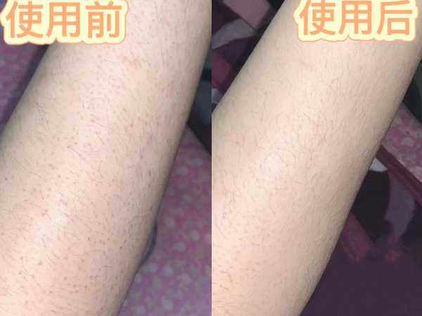㊙️只要俩步搞定鸡皮肤