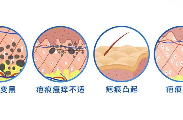 疤痕增生凸起了一块肉，好难看......那是因为没选对祛疤膏！