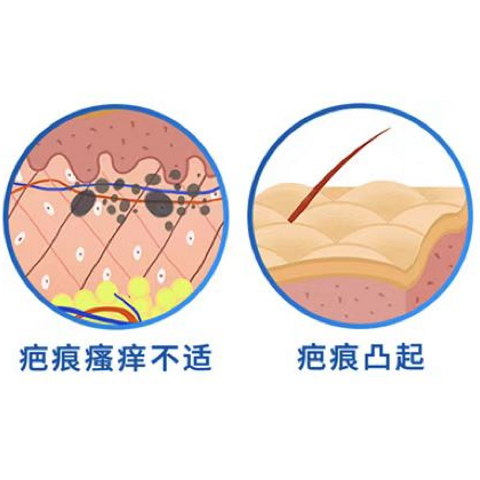 疤痕增生凸起了一块肉，好难看......那是因为没选对祛疤膏！