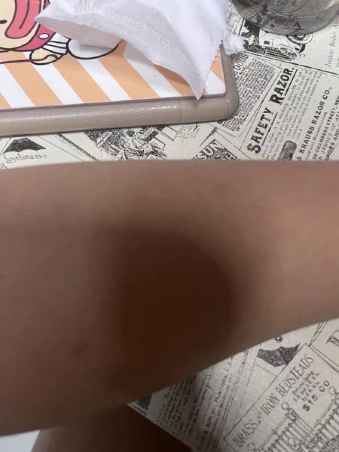 脱毛器