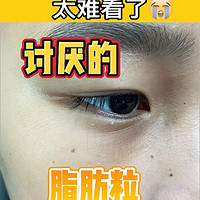 困扰多年的脂肪粒，后悔没有早点知道这个