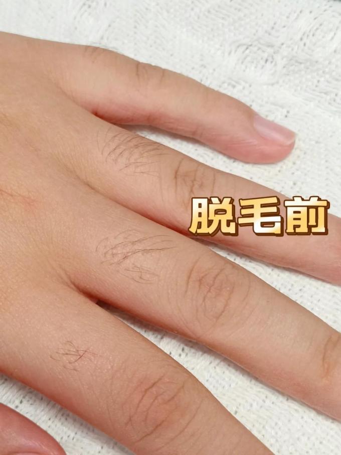摩立奥脱毛器