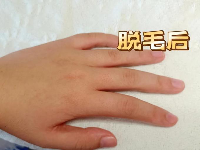 摩立奥脱毛器