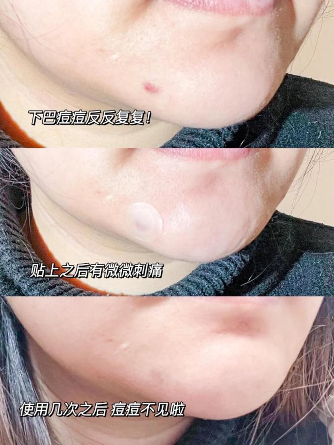 悦肤达面膜贴