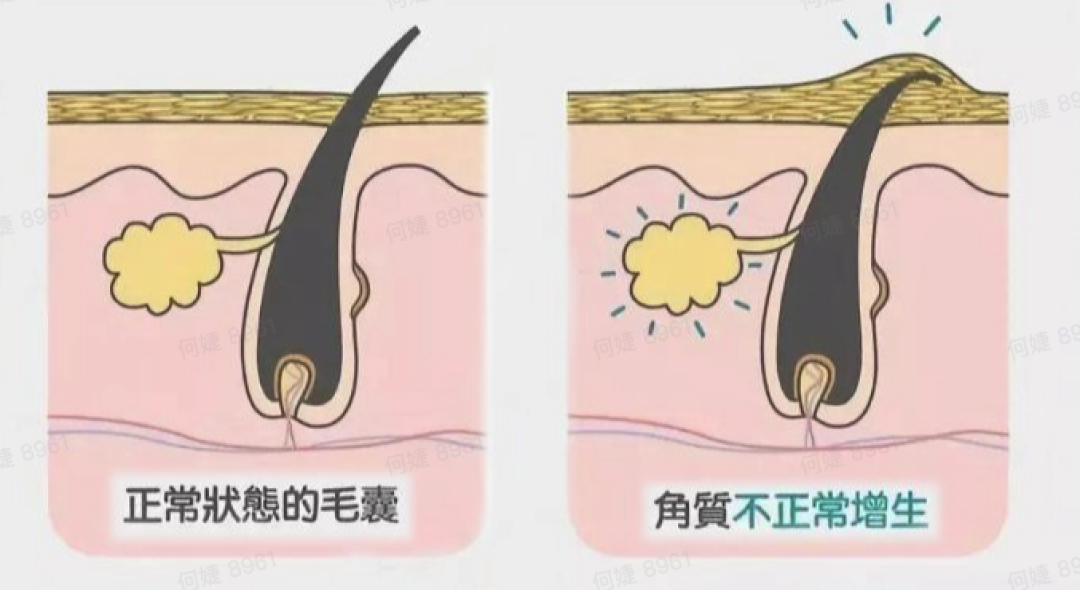 洗护美研所 | 早春拯救鸡皮大作战,助你拥有透亮嫩滑肌~