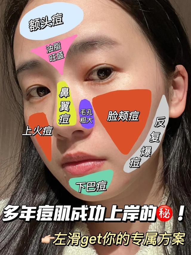 痘肌成功上岸㊙️！分级祛痘有点东西！