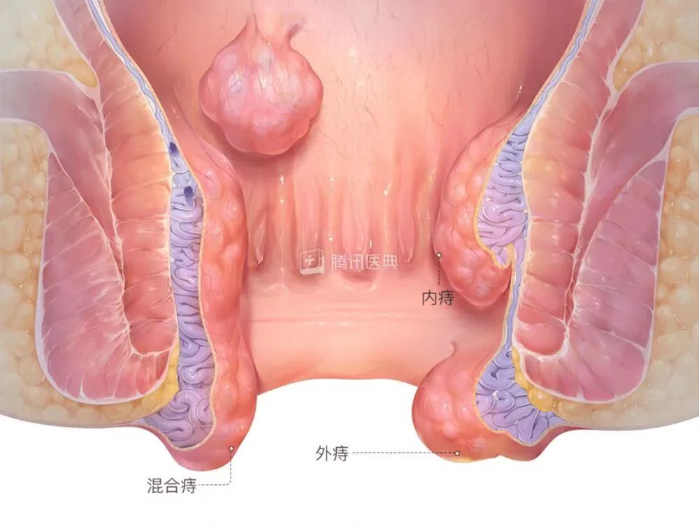 我都不好意思跟人说，我痔疮严重到需要输血！_运动健康_什么值得买