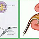 我得了肾结石——经输尿管钬激光碎石手术治疗过程