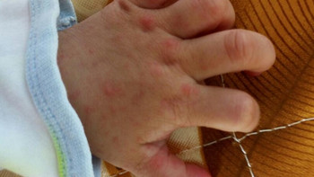 手足口病的防范，注意家里的孩子卫生。