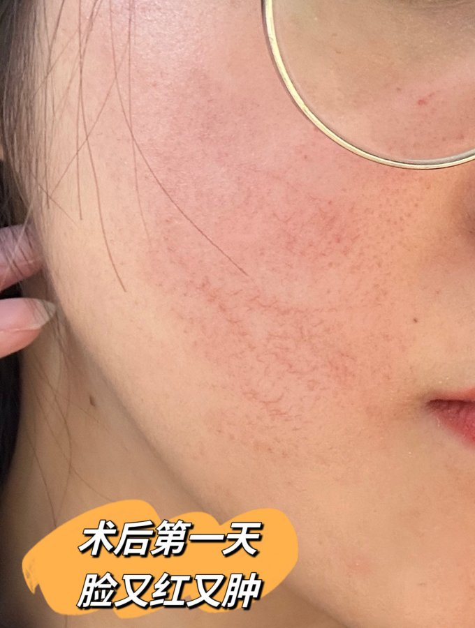 肤可新冷敷贴/敷料