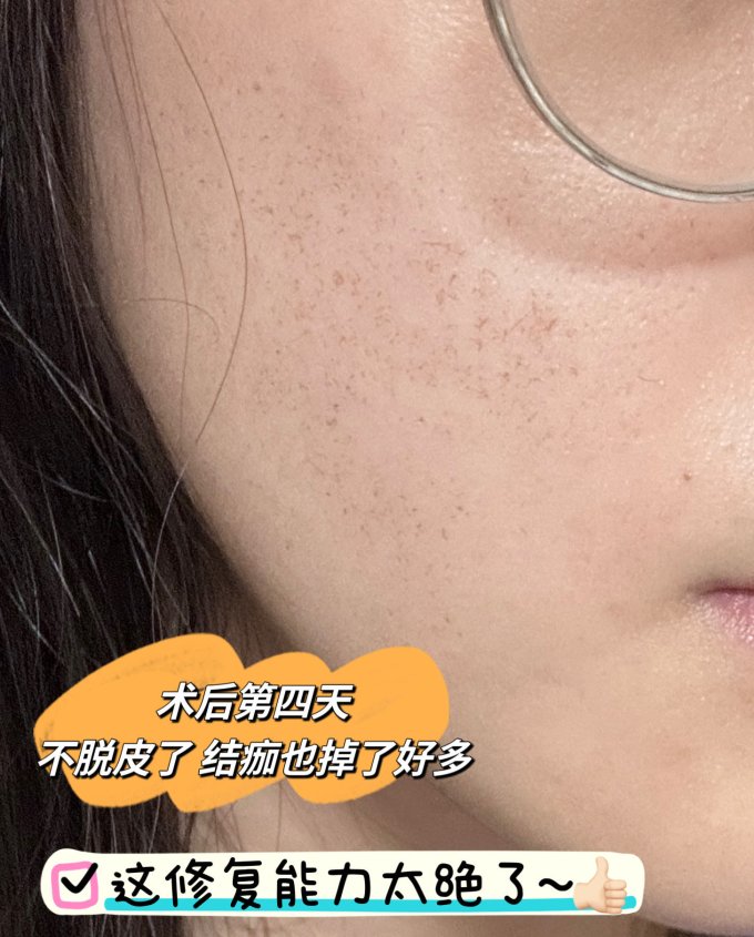 肤可新冷敷贴/敷料