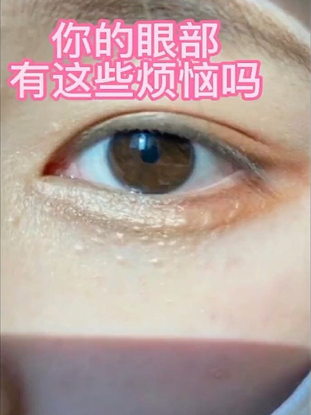 长脂肪粒到底怎么办？看我就对了！