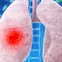 索托拉西布对KRAS G12C 突变非小细胞肺癌的疗效【医游记】