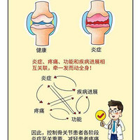 【自测】关节疼痛、肿胀、僵硬、咔咔响？远离中老年退行性关节炎，做好这三点!